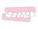 前牙外突(龅牙)