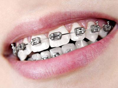 牙齿不整齐有哪些症状表现？