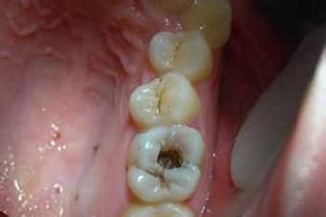 牙齿缺损有什么危害及注意事项？