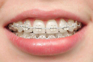 牙齿矫正的几种常用方法？