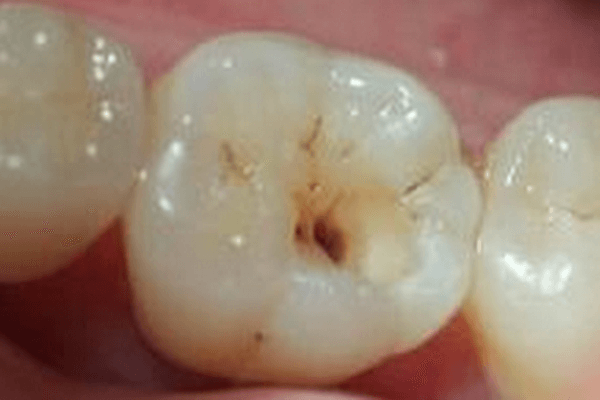 什么方法可以预防蛀了牙？