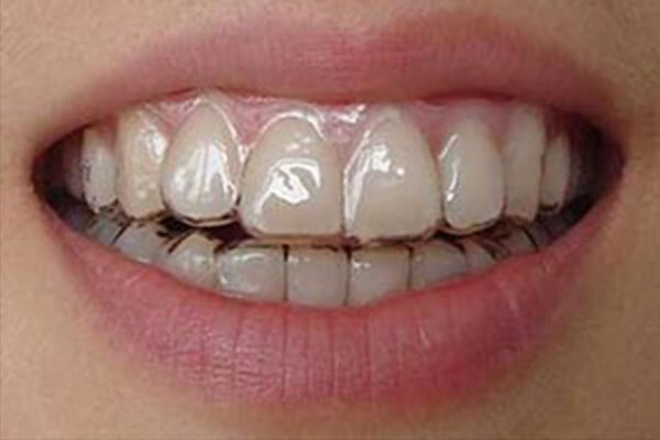 牙齿不齐做隐形矫正多少钱？