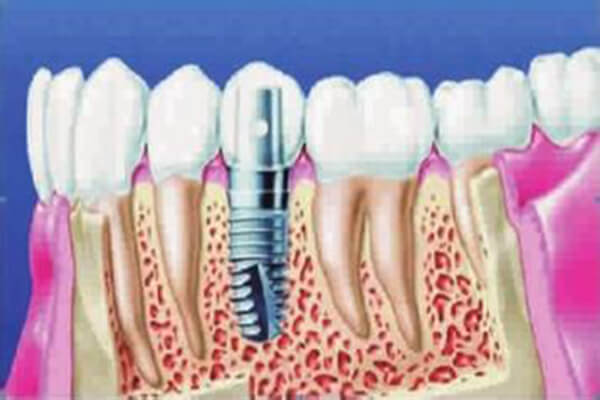 人工种植牙有哪些优点？