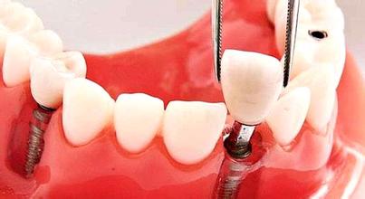 单个牙的种植义齿修复怎样完成？