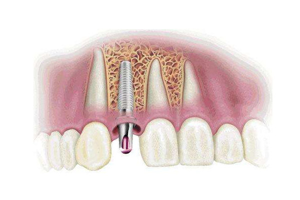种植牙的基本要求是什么