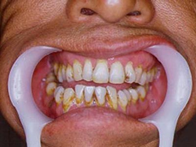 合肥好的口腔——牙缝过大怎么办？