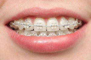 合肥口腔牙齿矫正？