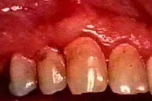 牙龈出血的诊断及治疗!牙龈出血是怎么回事?