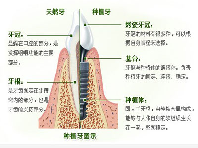 种植牙的治疗过程和优点