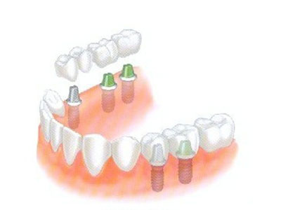 种植牙的治疗过程和优点