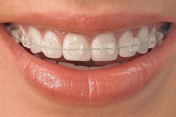 牙齿矫正的佳年龄？