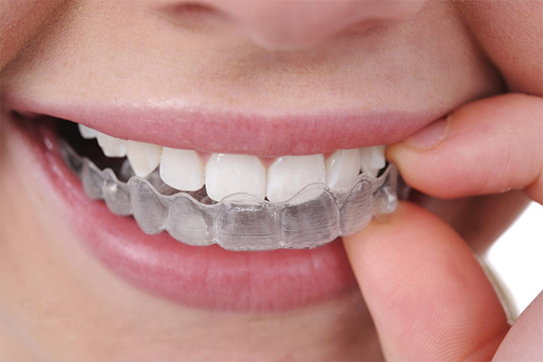 合肥隐形牙齿矫正大概要多少钱？