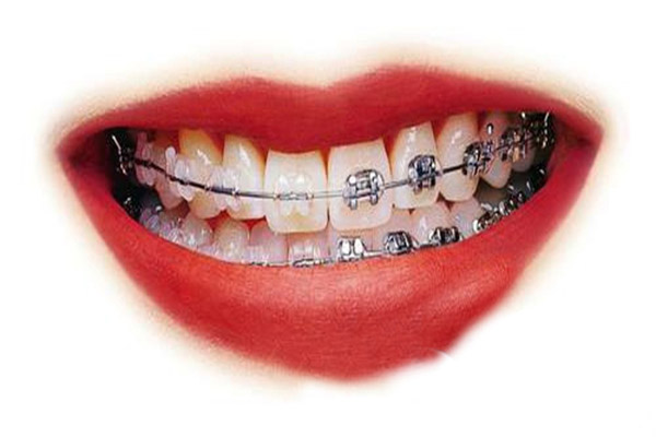 合肥牙齿正畸要多少钱？