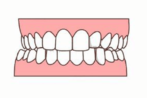 合肥牙颌面畸形的牙齿矫正要多少钱？