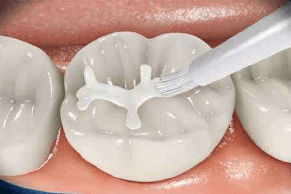 合肥补牙多少钱？