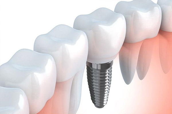 合肥牙科医院种植牙价格多少？