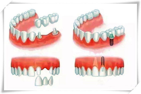 合肥镶牙的种类有哪些？