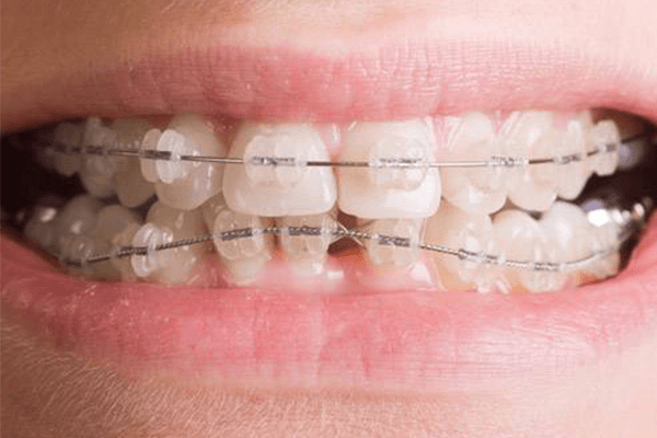 合肥牙齿正畸哪家好？
