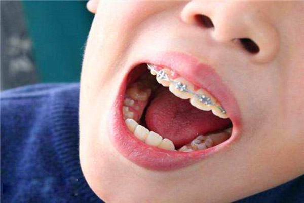 合肥儿童矫正牙齿哪家好？