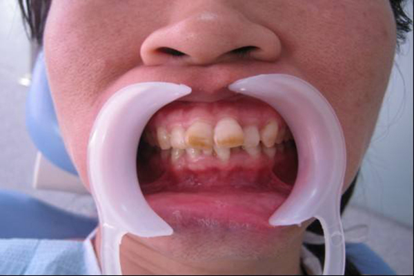 预防和治疗氟斑色牙的方法