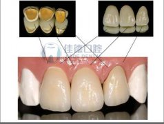 二氧化铝全瓷牙和二氧化锆全瓷牙的区别？