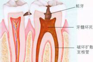 牙髓发炎根管的治疗过程