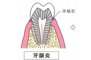 牙齿疾病的发展过程