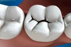 如何防止牙齿蛀了牙呢？