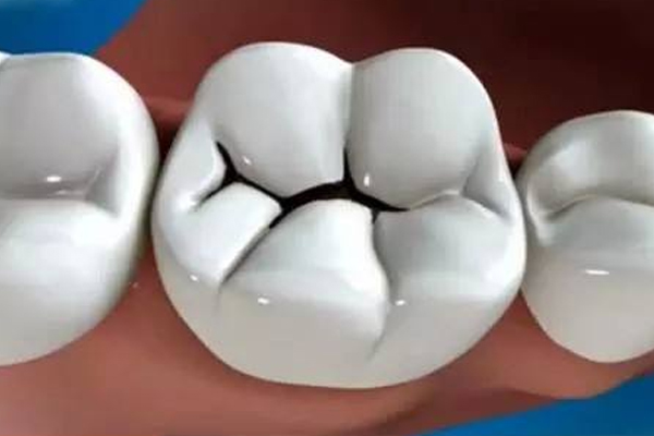 关于龋坏牙痛的治疗办法？