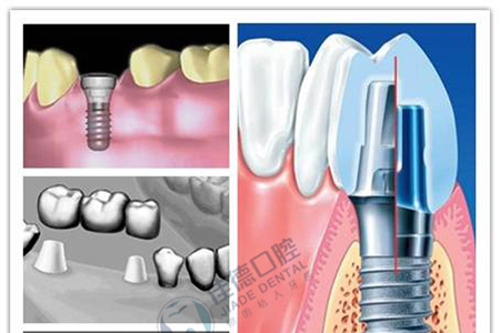 种植牙有危害吗