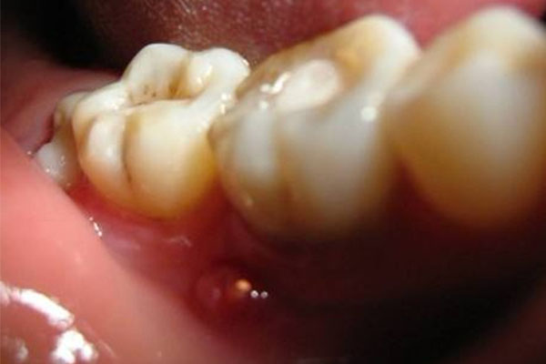 长智齿牙龈很疼怎么办呢？
