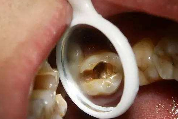 浅析引起牙痛的原因有哪些？