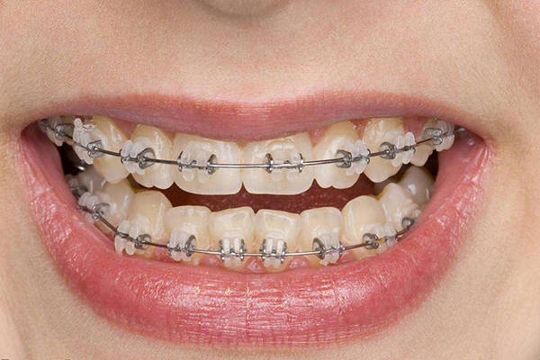 合肥牙齿矫正手术?