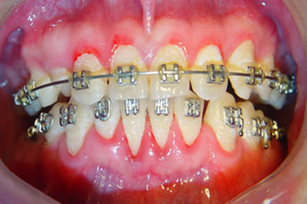司空见惯的牙齿矫正误区？