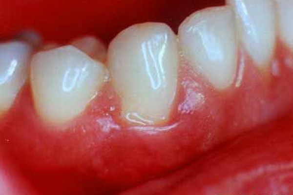 <b>牙周病的特点有哪些呢？</b>