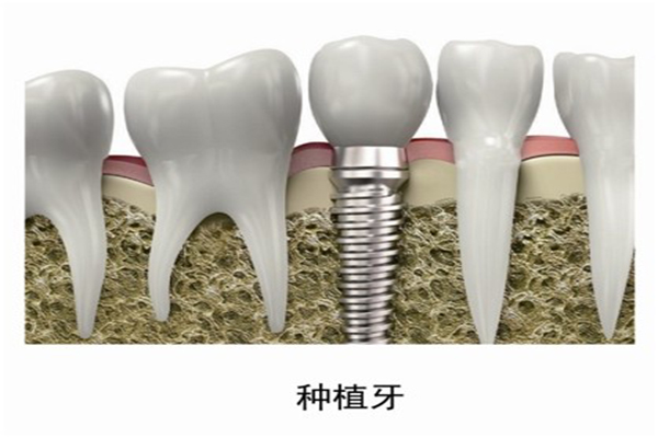 选择种植牙的材料非常重要？