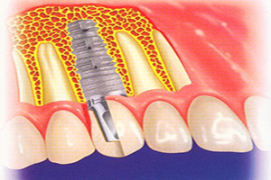 做种植牙都是用什么材料的？