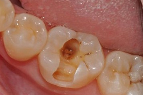 牙齿疾病我们该预防什么？