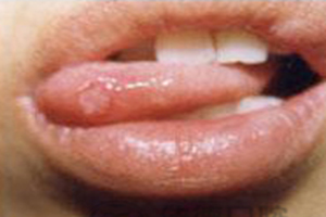 口腔溃疡的症状表现及引发原因？