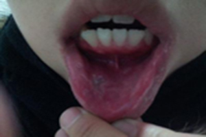 盘点牙齿问题的症状表现及治疗方案？