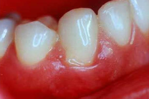 儿童牙齿疼痛的原因是什么？