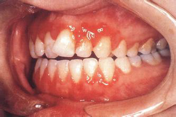 儿童常见牙龈炎有几种？