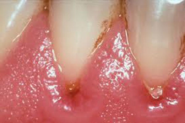 牙龈出血应要怎么治疗?
