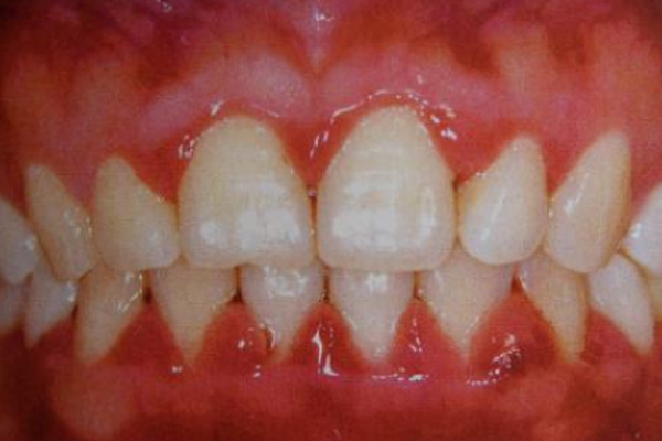<b>怎样有效预防牙周病？</b>