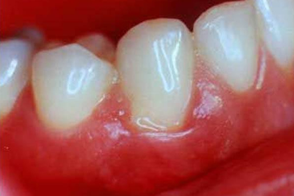 牙龈肿痛该怎么办？
