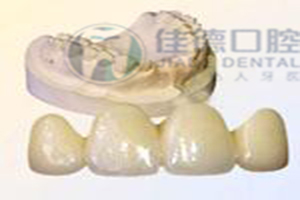 烤瓷牙用什么样的材质比较好?