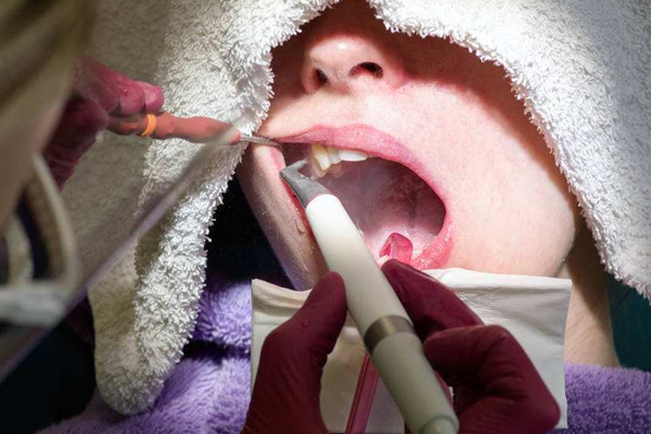 关于洗牙与喷砂洗牙的区别是什么？