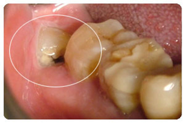 牙痛较常见的六大原因？