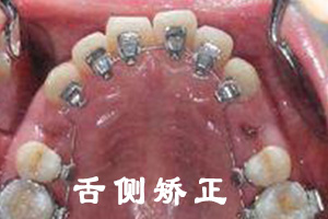 传统矫正和隐形矫正哪种比较好?
