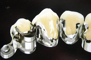 合肥做镶牙修复要多少钱？